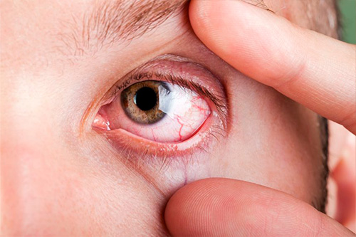 alergia2-dra-joyce-farat-oftalmologia