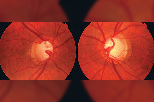 glaucoma-dra-joyce-farat-oftalmologia
