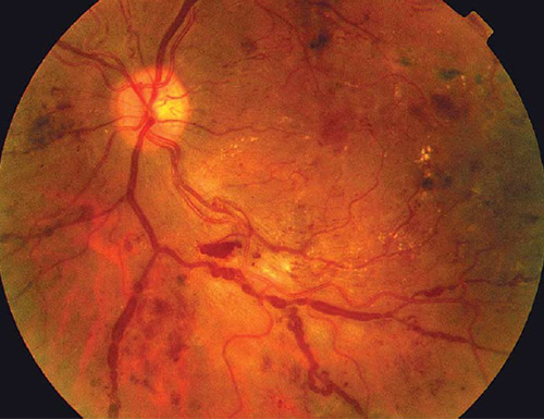 retinopatia-dra-joyce-farat-oftalmologia