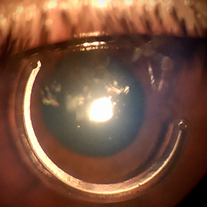 anel-estromal1-dra-joyce-farat-oftalmologia