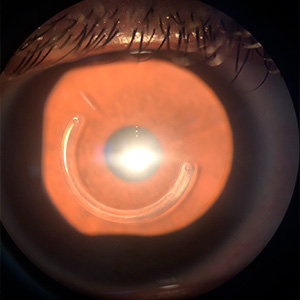 anel-estromal2-dra-joyce-farat-oftalmologia
