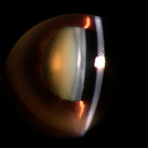 catarata202-dra-joyce-farat-oftalmologia